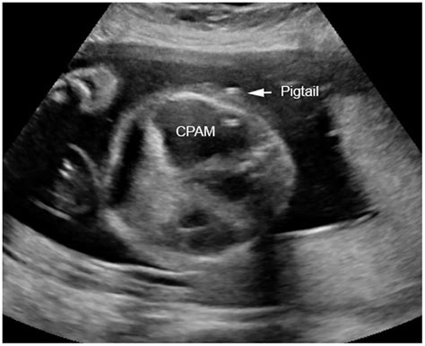 ccpamd|cpam macrocystic type.